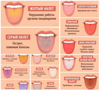 12 проблем, о которых может рассказать цвет языка..png